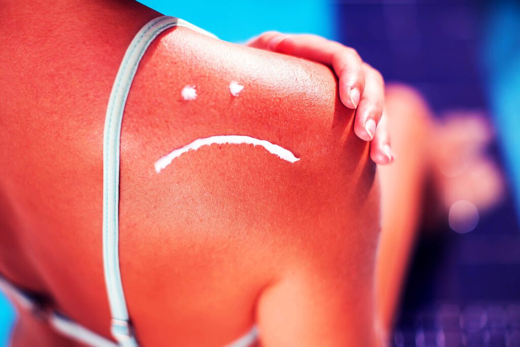 Unveiling The Key Triggers Of Sunburn: A Fresh Perspective